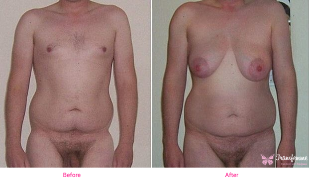 Male Breast Enlargement Photo,male feminization photos